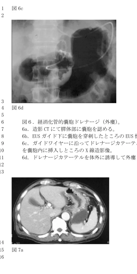 図 6c 1  2  3  図 6d 4  5  図６．経消化管的嚢胞ドレナージ（外瘻） 。 6  6a．造影 CT にて膵体部に嚢胞を認める。 7  6b．EUS ガイド下に嚢胞を穿刺したところの EUS 像。 8  6c．ガイドワイヤーに沿ってドレナージカテーテル 9  を嚢胞内に挿入しところの X 線造影像。 10  6d．ドレナージカテーテルを体外に誘導して外瘻とした。 11  12  13  14  図 7a 15  16 