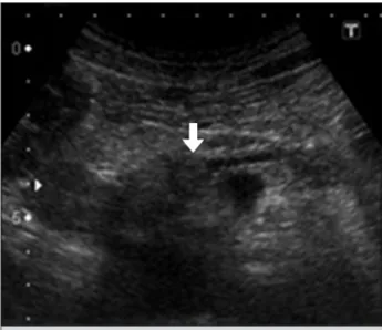 Fig. 1 A  US  study  shows  a  solitary,  heterogeneous  and hypoechoic  mass  with  a  clear  margin,  1  cm  in  diameter,  in  the head of the pancreas (arrow).