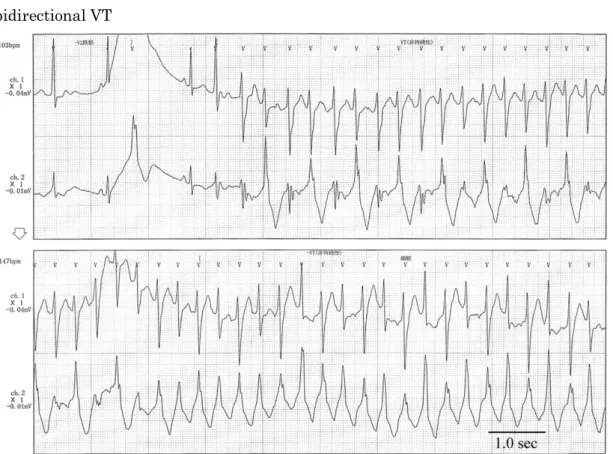 図 6  Andersen-Tawail 症候群（KCNJ2 遺伝子  p.Arg67Trp 変異例）で見られた bidirectional VT 