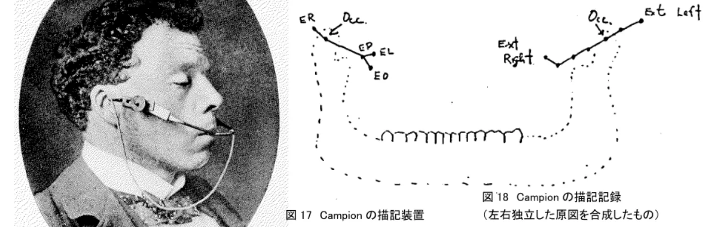 図 17　Campion の描記装置 