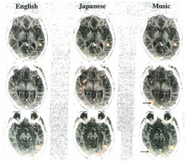 Fig. 1. 英語、日本語、音楽に精通した29歳日本人男性の典型的なfMRI画像