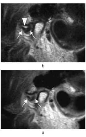 Table 2 Relationship between increased signal intensity from retrodiscal tissue on T2W images and joint fluid status Increased signal intensity from retrodiscal tissue No