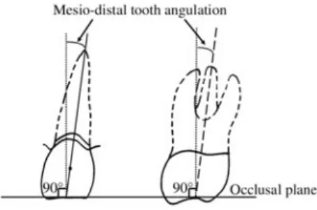 Fig. 1 Mesio-distal tooth angulation Mesio-distal tooth angulation is a complementary angle, where the long axis of the clinical crown (long dots) is measured from a line at 90 degrees to the occlusal plane.