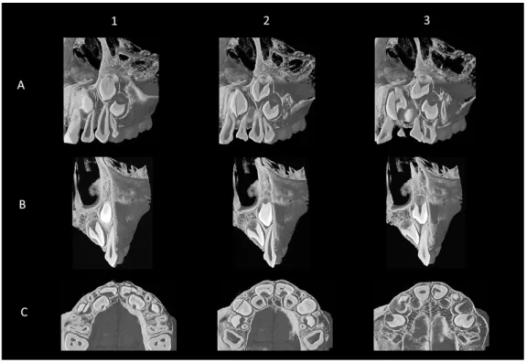 Fig.  3  Micro-CT image of Stage II