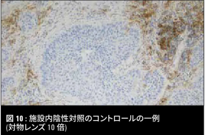図 12 : 一次抗体コントロールで染色した非小細胞肺癌症 例組織検体では、腫瘍細胞膜は染色されない  (対物レンズ 20 倍) » 施設内コントロール細胞を、結 果の解釈の一助として使用しな いでください。 一次抗体陰性コントロールで染色した陽性 対照および陰性対照の施設内コントロール 組織検体を観察し、腫瘍細胞に偽陰性がみられないことを確認してください。腫瘍細胞の細胞膜が染色されていないことが必要です ( 図 12)。 一次抗体陰性コントロールで染色した組織検体スライドを観察し、一次抗体染色スライドの判