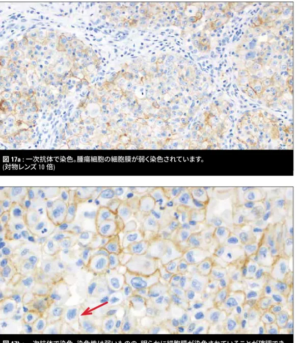 図 17b : 一次抗体で染色。染色性は弱いものの、明らかに細胞膜が染色されていることが確認でき ます (矢印)。(対物レンズ 40 倍) 図 17a : 一次抗体で染色。腫瘍細胞の細胞膜が弱く染色されています。 (対物レンズ 10 倍) 非小細胞肺癌症例のさまざまな染色像とその解釈 弱いが細胞膜染色が認められる場合  観察倍率に関わらず、明らかな細胞膜染色を示す細胞はスコアリングに含めます。  不確かな場合は、高倍率で確認してください。 重要なポイント       細胞が染色強度≧ 1+ の細胞膜染色を呈