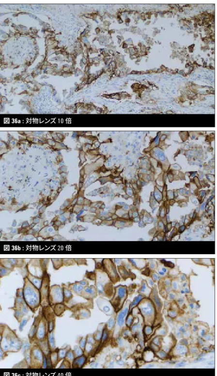 図 36a-36c : PD-L1高発現 （TPS ≧ 50%）図 36a : 対物レンズ 10 倍
