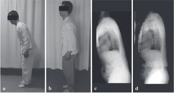 Fig. 3  パーキンソン病に合併した SCN 障害性腰痛の治療前後における姿勢の変化（文献 28 から引用） a，c：術前，b，d：術 4 カ月後．
