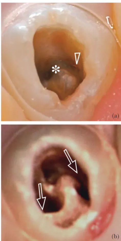Fig.  4  Coronal view before pulp chamber was opened (a)  Dark-stained  dentin  (arrowhead)  provided  clues  to  location of mesial pulp chamber