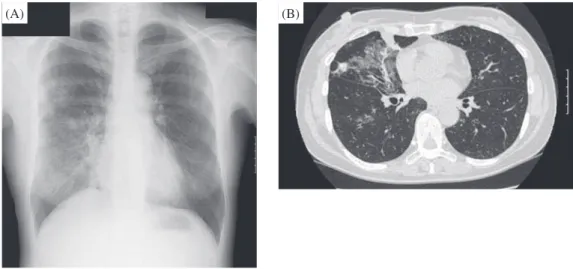 Fig. 2 Chest X-ray revealed inﬁltration shadows in the middle and lower ﬁeld of the right lung (A)