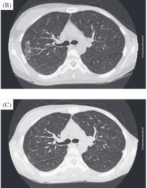 Fig. 3 Chest X-ray revealed inﬁltration shadow  in the right lower lung ﬁeld before treatment (A)