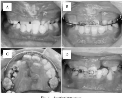 Fig. 4 Anterior expansion