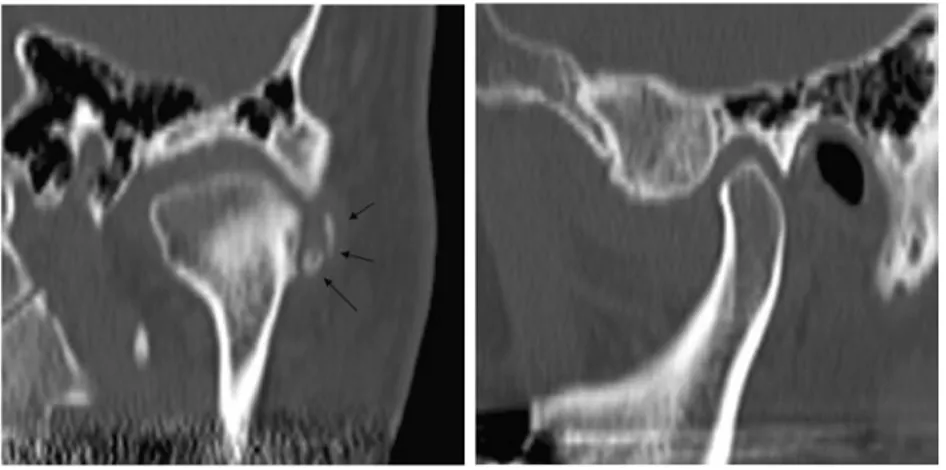 Fig. 3 Multiplaner reformation (MPR) image of CT Left photograph is coronal view. Right photograph is sagittal view.