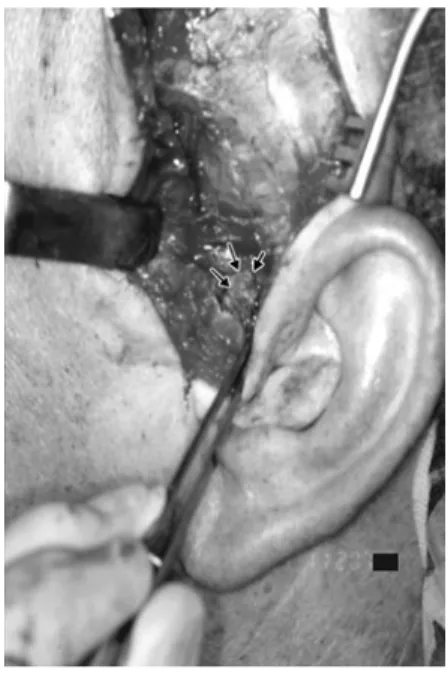 Figure 6 shows osseous hard tissue resected from the lateral aspect of the mandibular condyle.