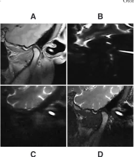 Figure 2 shows the DWI and PDWI obtained.