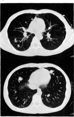 Fig.  1  Chest  CT  on  admission  showed  multiple arteriovenous fistulas  in  both  lungs  except  for right  S1,  S5,  and  left  S1+2