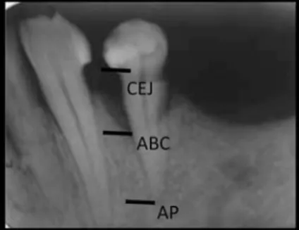 Fig. 2 Reference for alveolar bone loss assessment