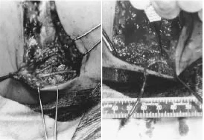 Fig. 1 The greater auricular nerve