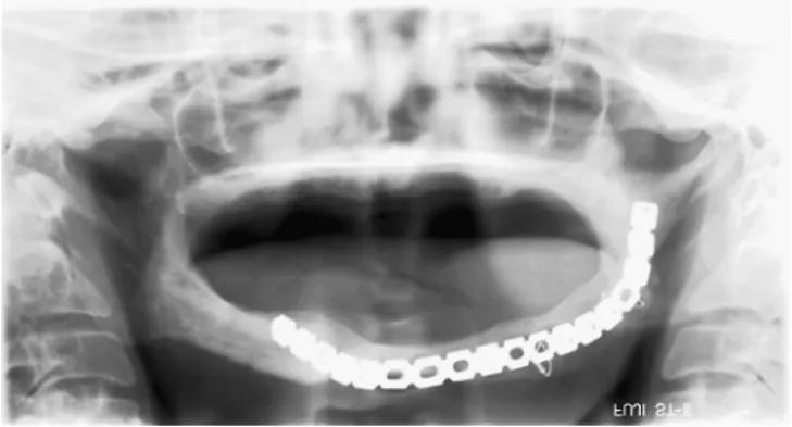 Figure 2 shows the complete dentures that  were fitted in 1985 and are currently in use.