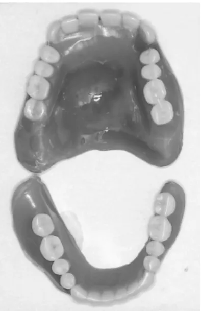 Fig.  3  Lower denture in use: view of basal surface Artificial  teeth  before  and  after  left  canine  positioned  closer to labial side than buccal denture border.