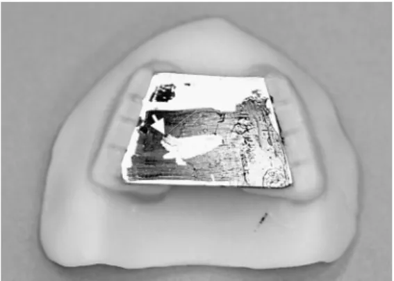 Fig.  4  Gothic arch tracing confirmed limitation of  movement  to  right  side  caused  by  ablative  surgery to left lower jaw