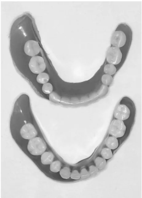 Fig.  6  Incomplete closure of left side of lips