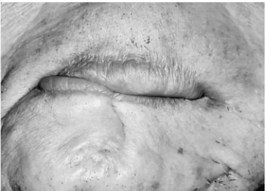 Fig.  8  Closure  of  lips  was  improved  by  reducing  occlusal vertical dimension