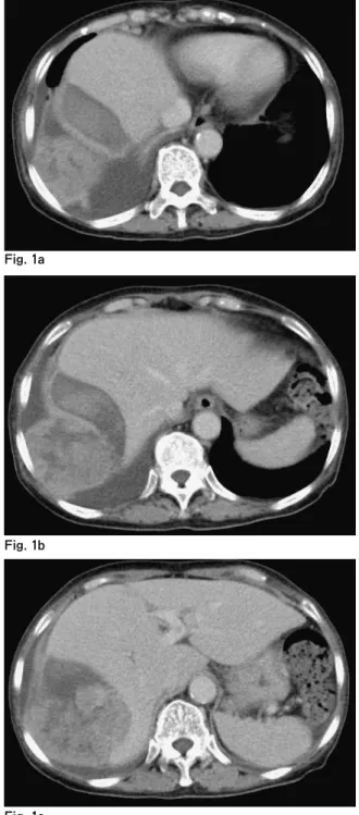 Fig.  1a-c　The  preoperative  diagnosis  was  a  tumor  of  diaphragm  origin,  because  the  tumor  appeared  to  be  located  on  both  the  cranial  and  caudal  sides  of  the  diaphragm.