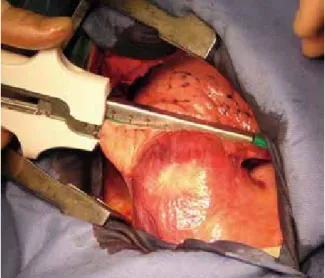 Fig.  3b　The  lower  part  of  the  right  lung  was  dissected  with autosuturing.