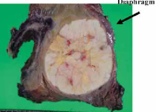 Fig. 3d　Photograph after resection of the right liver lobe  and partial resection of the right lung.