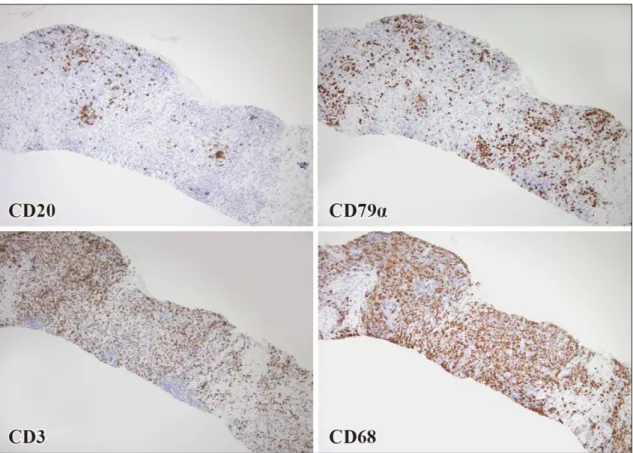 Fig. 7 Immunohistological study reveal that sites of CD79α, CD3, CD68 are positive, and CD20 is negative.