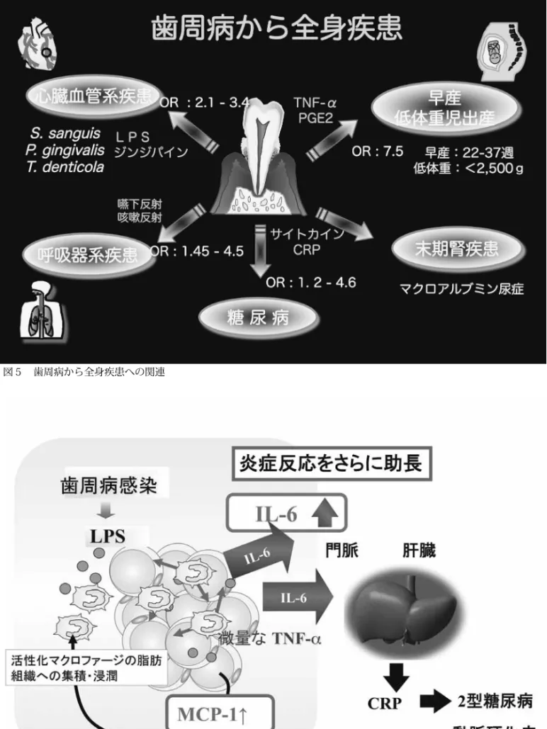図 6　歯周病と脂肪細胞との関わりで助長される全身性炎症