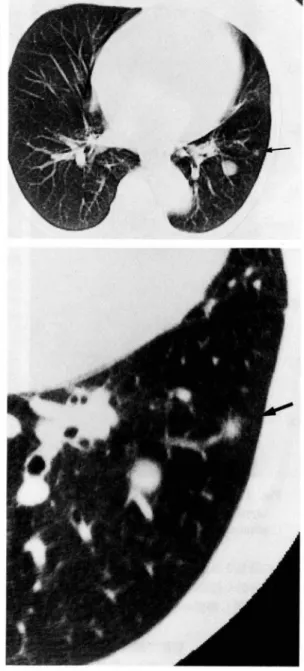 Fig.  1  Chest  X-ray  film  on  admission  showing  a well-circumscribed  nodular  shadow  in  the  left lower  lung  field.
