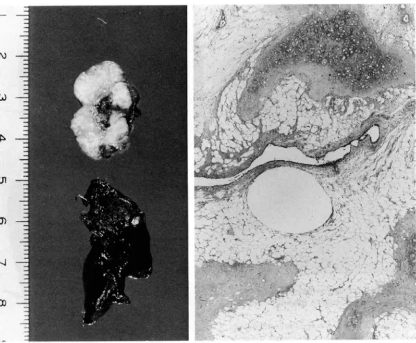 Fig.  4  Macroscopic  view  of  hamartoma (upper)  and  wedge-resected  specimen  of adenocarcinoma  (lower)