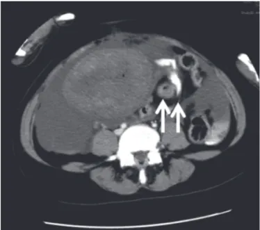 Figure 2　Therapeutic strategy of Damage Control Surgery（Case1） Emergency  total  hysterectomy  and  gauze  packing  were  performed  along  with  transcatheter  arterial  embolization（TAE）