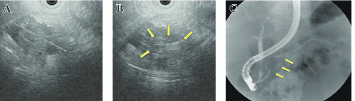 Fig. 3.   Findings of ultrasonography.  A. Endoscopic ultrasound (EUS) show the cyst 5.3×3.0 cm, B