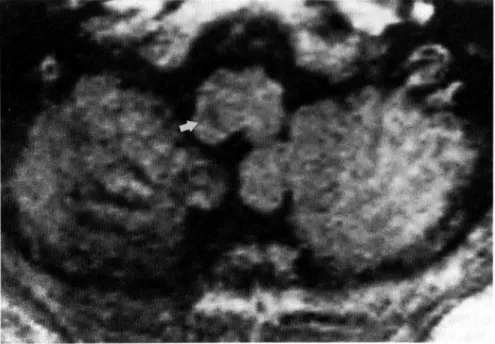 Fig.  2  Axial   Ti-weighted  magnetic  resonance  image  showing  a  small  area  of  decreased  signal  in  the  left  margial  area  at  the  junction  of  the  ventral  and  the  dorsal  portion  of  the  medulla  (arrow).