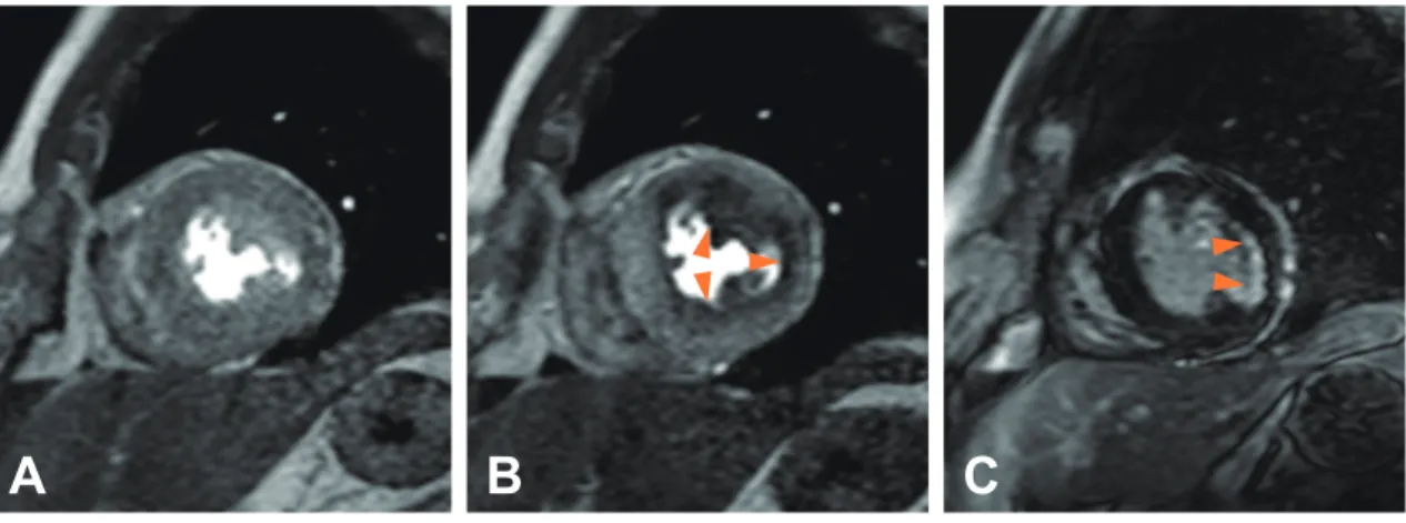 図 2　50 代男性，胸痛．3T 安静時心筋血流 MRI（A），負荷心筋血流 MRI（B），遅延造影 MRI（C）．