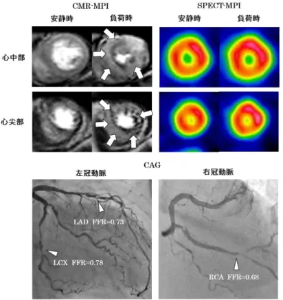 図 9    MVD 患者における CMR-MPI と SPECT-MPI の一例  LAD FFR=0.73，LCX FFR=0.78，RCA FFR=0.68 と MVD (3 枝疾患)  を呈する患 者において， SPECT-MPI では集積異常を認めなかったが，CMR-MPI で心内膜下虚 血   (白矢印)  を認めた  4.2.3  DSE と CMR-MPI の比較  DSE もまた心筋虚血診断，治療の指標として広く日常臨床で施行されていて，その 診断精度は SPECT-MPI に匹敵するとさ
