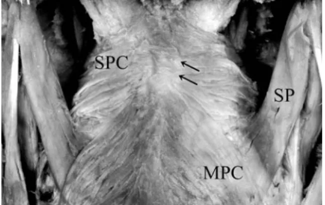 Fig. 12 Morphology of the insertion of the superior pha- pha-ryngeal constrictor muscle as observed from the posterior direction（type A）