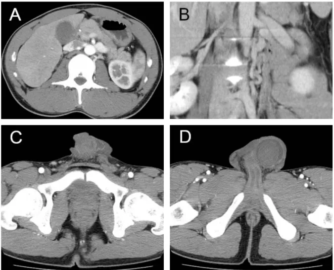 Fig. 1. (A) Dilated left renal vein, (B) dilated left gonadal vein, (C) swollen left spermatic cord, and (D) ﬂuid collection around the left testis were revealed by computed tomography.