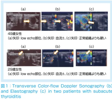 図 1：Transverse  Color-flow  Doppler  Sonography （b）  and  Elastography （c） in  two  patients  with  subacute  thyroiditis 49歳女性 （a）矢印：low echo部位、 （b）矢印：血流±、 （c）矢印：正常組織よりも硬い29歳女性（a）矢印：low echo部位、（b）矢印：血流±、（c）矢印：正常組織よりも硬い（a）（b）（c）（a）（b）（c）