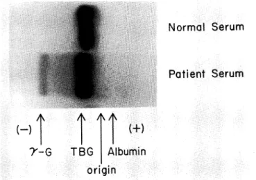 Fig.  6.  Radioautography  of  '25  I-T3  binding.  In  normal  serum  the  radioactivity  is  seen  only  at  the  TBG  fraction,  but  in  patient  serum  the  radioactivity  is  seen  at  the  gamma  globulin  fraction,  too.
