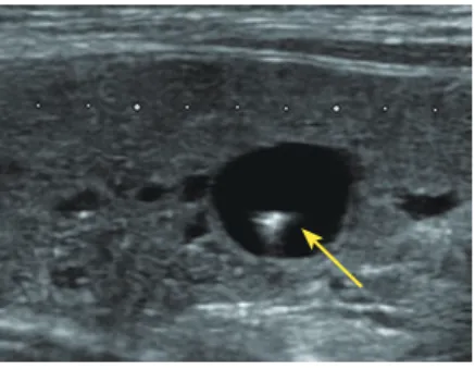 図 6　甲状腺乳頭癌の超音波像 A. 形状不整、内部低エコー、微細多発高エコーを認める B. 粗大高エコー、接した低エコー部に乳頭癌を認めた 図 7　コメットサインコロイド嚢胞を示唆する瘤・リンパ節転移に大別される。良悪性の診断に穿刺吸引細胞診は不可欠だが、全例に施行されるわけではない。甲状腺結節取扱いガイドラインは細胞診の適応基準を以下推奨している16）。1、充実性結節：①20mm径より大きい結節② 5mm 〜20mm 径において、10mm 径以上では超音波検査で何らかの悪性を示唆する所見がある場合、5m