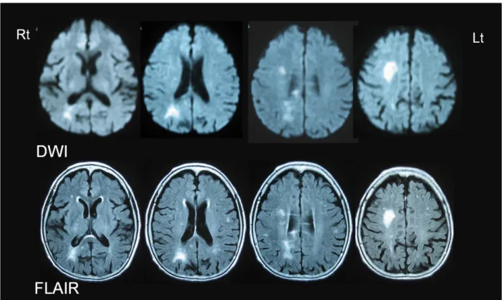 図 2  入院時頭部 MRI 