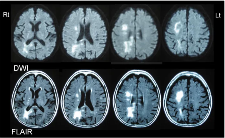 図 4  2009.6.12  頭部 MRI（拡散強調画像 DWI、FLAIR 画像） 