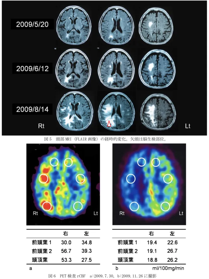 図 5  頭部 MRI（FLAIR 画像）の経時的変化。矢頭は脳生検部位。 