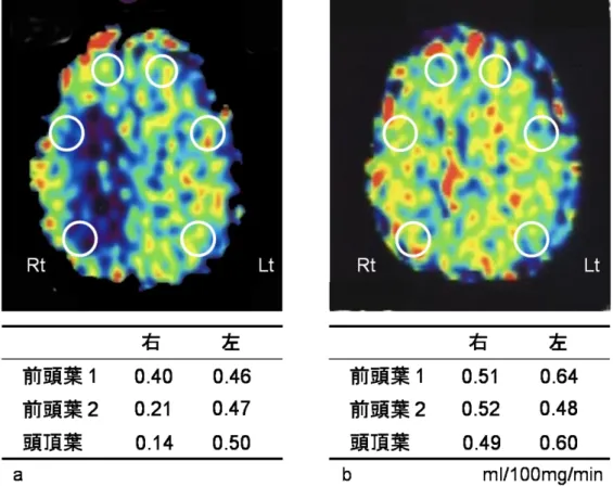 図 7  PET 検査 rCMRO 2   a:2009.7.30，b:2009.11.26 に撮影