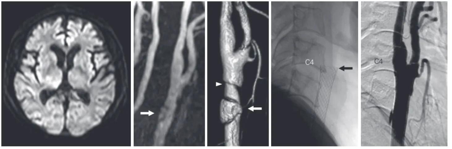 Fig. 2  A: Diffusion-weighted magnetic resonance (MR) image showing no acute cerebral in- in-farctions.