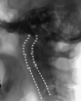 Fig. 4   Postoperative angiograms (A：AP view and B：lateral view). Stenosis and stasis of the contrast  agent have disappeared.